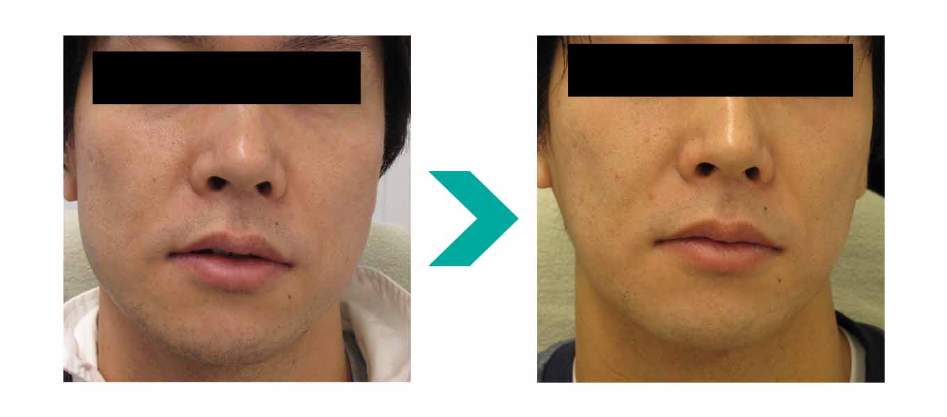 エラボトックス注射前後、テティス横濱美容皮膚科症例写真
