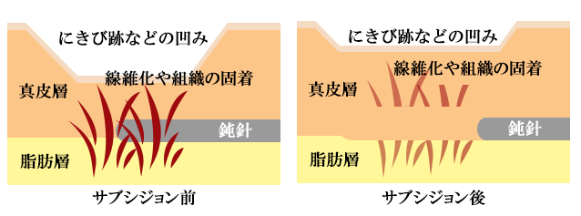 サブシジョン(subcision)とは