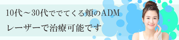 ADMを神奈川、横浜でレーザー治療