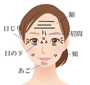 しわ、表情じわ治療、笑いじわ、眉間のしわ、額のしわ