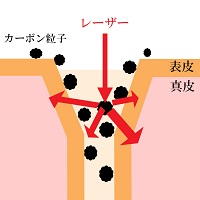 カーボンピーリングとは